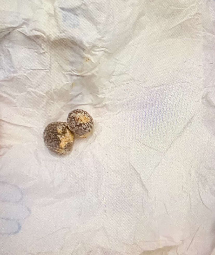 लमजुंग अस्पतालमा पितथैलिको अप्रेशन सुरु !