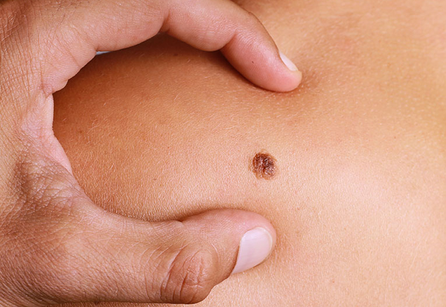 विश्व क्यान्सर दिवस विभिन्न सचेतनामूलक कार्यक्रम गरी मनाईदै।